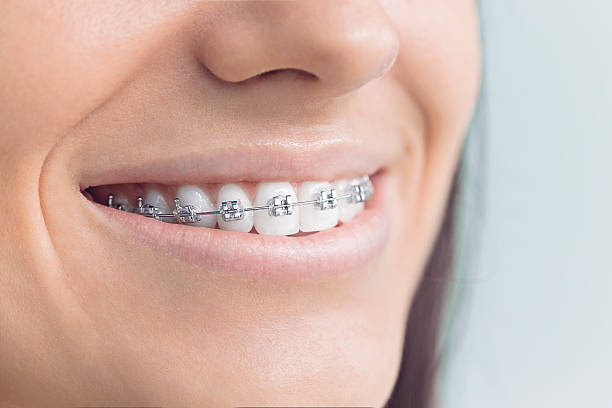 Best Traditional Braces  in La Riviera, CA